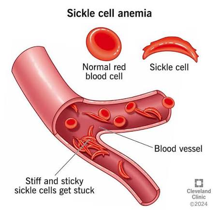 Sickle Cell